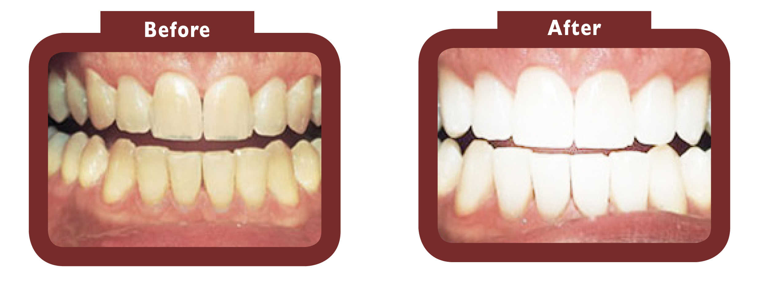 before and after teeth whitening - LA TEETH England