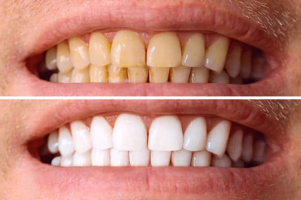 Laser White For Ever Bright – Get a Brighter, Whiter Smile with LA Teeth Whitening England