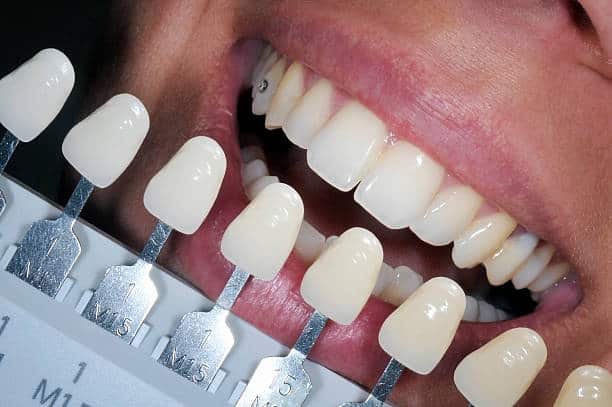 Get Natural and Stunning Smile with Teeth Whitening Results from LA Teeth Whitening England