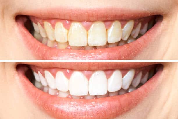 Achieve a Dazzling Smile for Your Special Day: A Guide to Wedding Teeth Whitening England