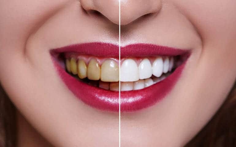 Teeth Whitening Ascot Windsor England