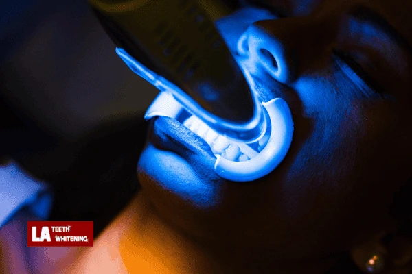 How Much Does Laser Whitening Cost in the UK? England