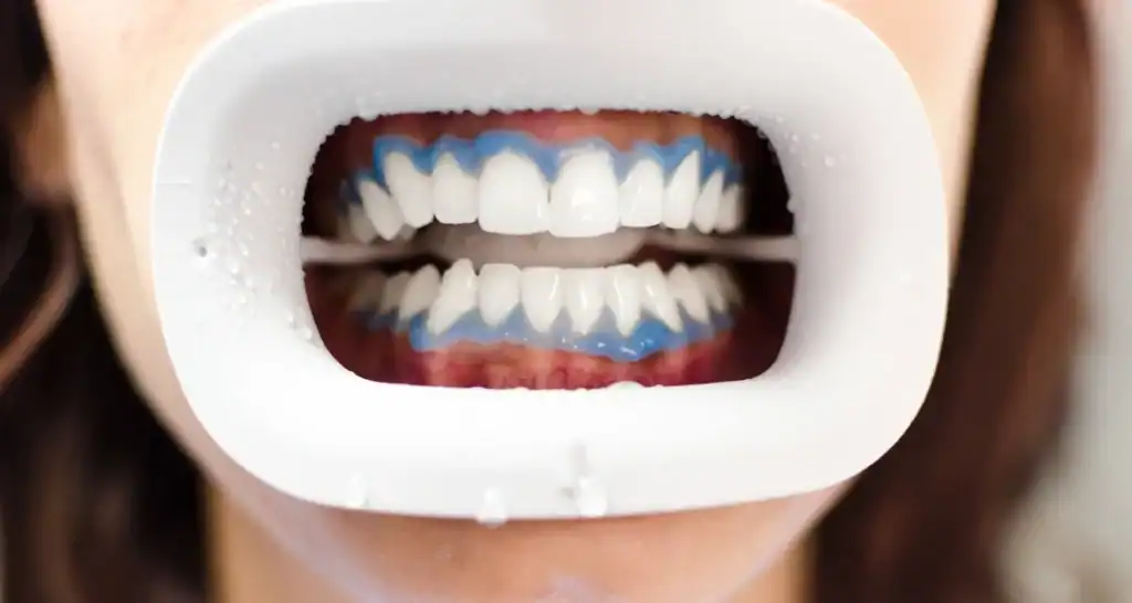 Is Professional Whitening Better Than At-Home Kits England