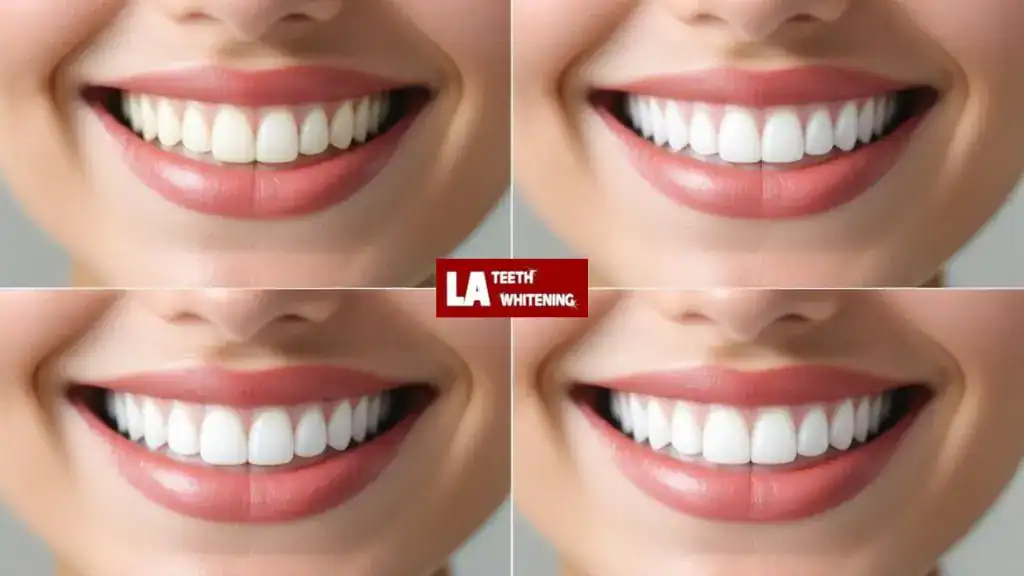 Whitening Before or After Getting Veneers: What’s Best England